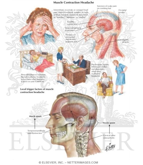 Watermarked preview of labeled image: Muscle Contraction Headache