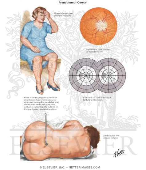 Watermarked preview of labeled image: Pseudotumor Cerebri