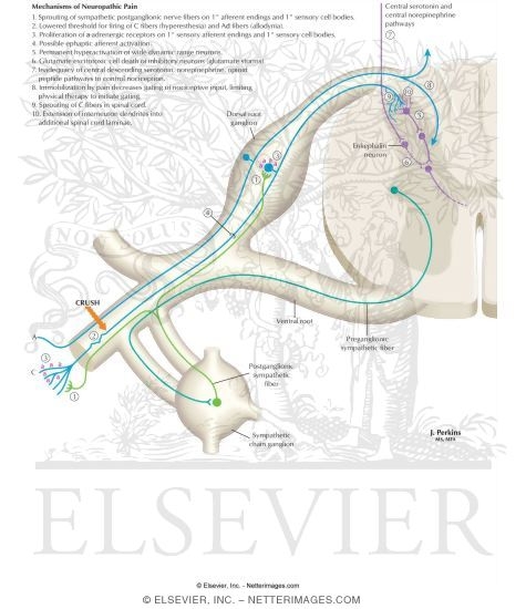 Watermarked preview of labeled image: Mechanisms of Neuropathic Pain and Sympathetically Maintained Pain