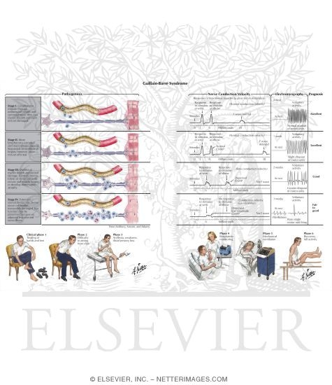 Guillain-Barre Syndrome