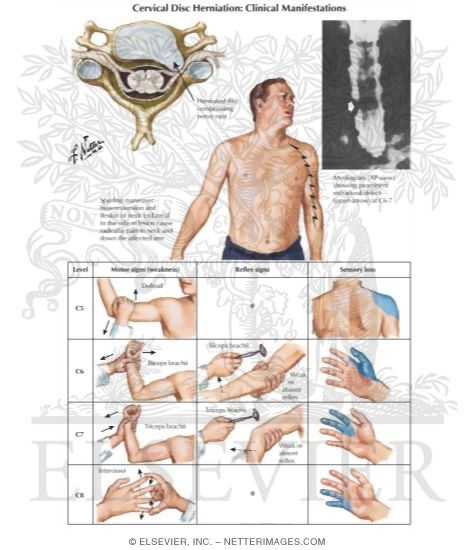 Watermarked preview of labeled image: Cervical Disc Herniation: Clinical Manifestations