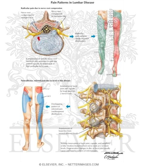 Pain Patterns in Lumbar Disease