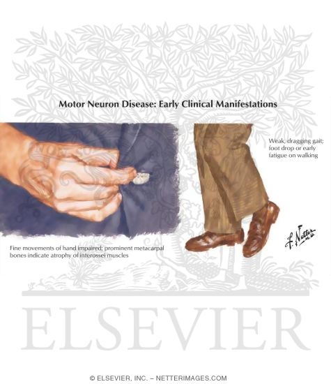 Watermarked preview of labeled image: Motor Neuron Disease: Early Clinical Manifestation
