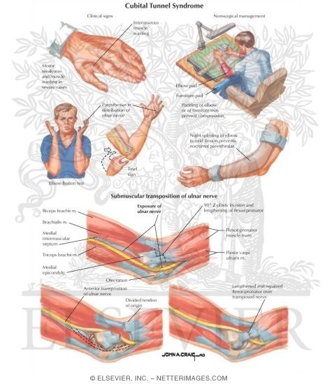 Cubital Tunnel Syndrome