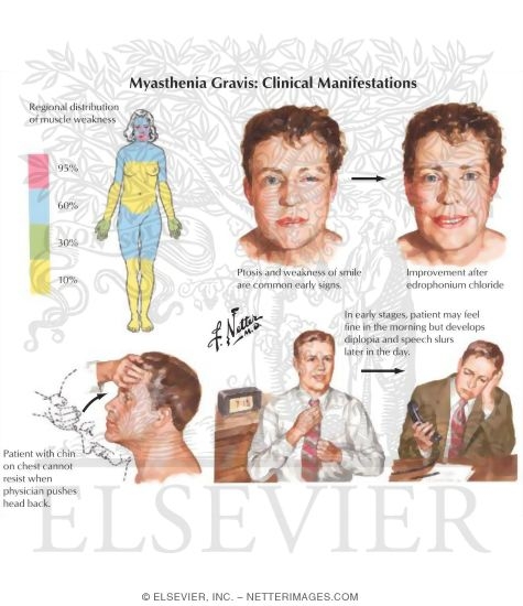 Myasthenia Gravis: Clinical Manifestations