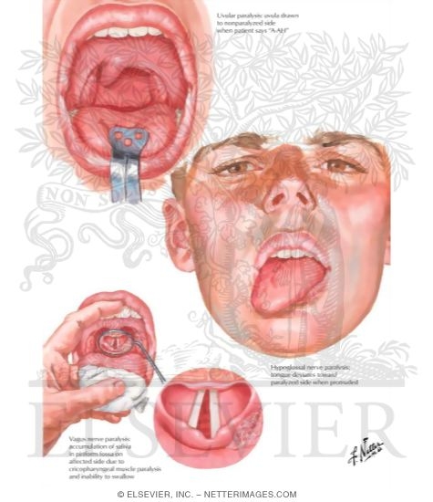 Watermarked preview of labeled image: Neurogenic Disorders of Mouth and Pharynx