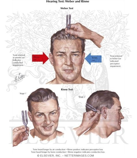 Auditory Nerve Testing: Weber and Rinne Testing