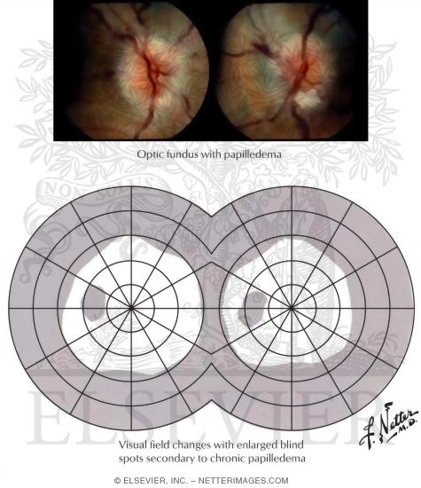 Effects of Increased Intracranial Pressure On Optic Disk and Visual Fields