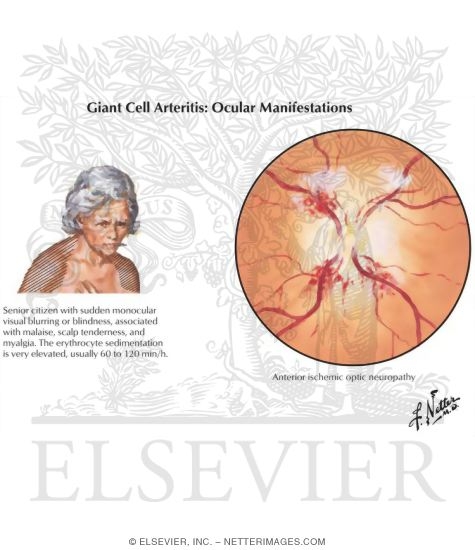Giant Cell Arteritis: Ocular Manifestations