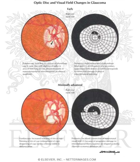 Optic Disc and Visual Field Changes In Glaucoma