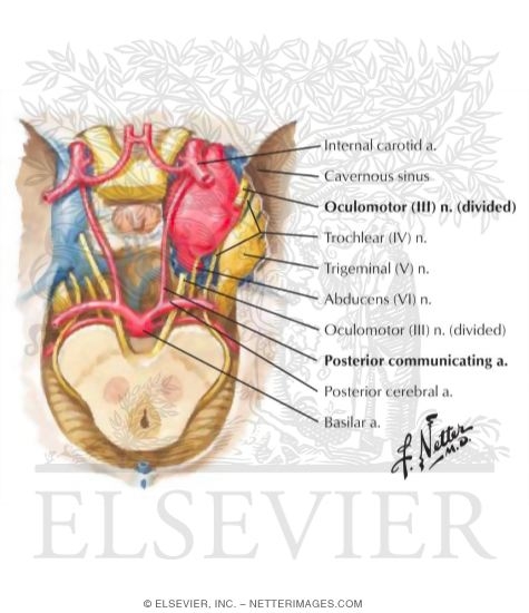 Posterior Communicating Artery Aneurysm Compressing Cranial Nerve III