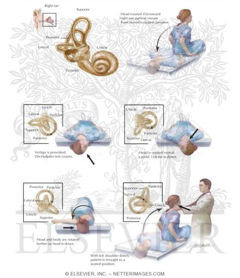 Canalith Repositioning (Epley Maneuver)