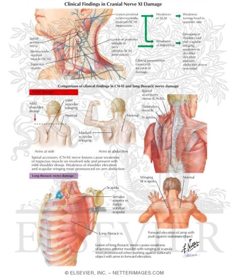 Clinical Findings In Cranial Nerve XI Damage