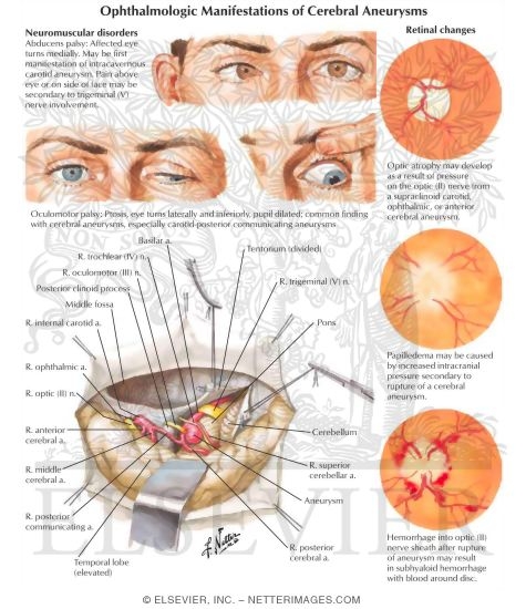 Watermarked preview of labeled image: Ophthalmologic Manifestations of Cerebral Aneurysms