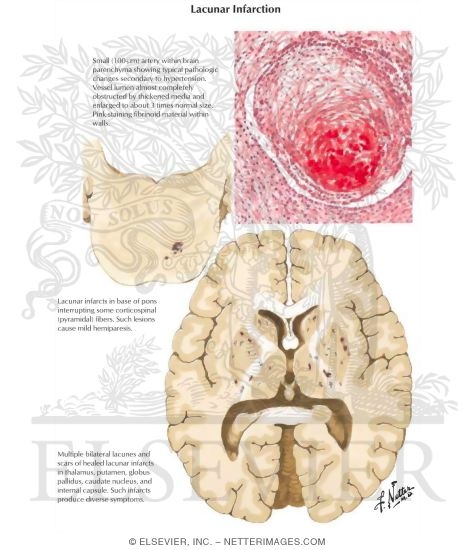 Lacunar Infarction