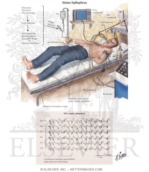 Watermarked preview of labeled image: Status Epilepticus