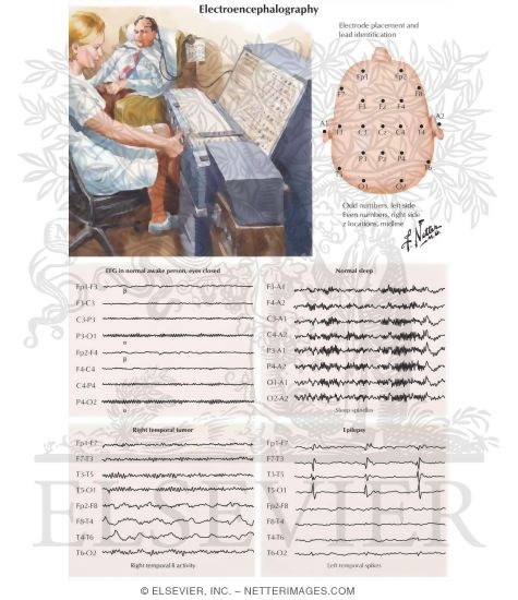 Electroencephalography