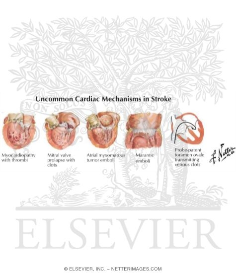 Watermarked preview of labeled image: Uncommon Cardiac Mechanisms In Stroke