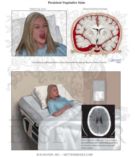 Watermarked preview of labeled image: Persistent Vegetative State