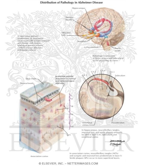 Watermarked preview of labeled image: Distribution of Pathology In Alzheimer Disease