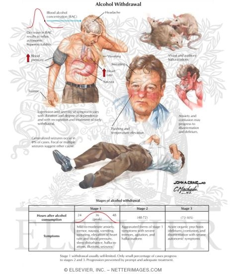 Watermarked preview of labeled image: Alcohol Withdrawal