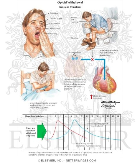 Watermarked preview of labeled image: Opioid Withdrawal