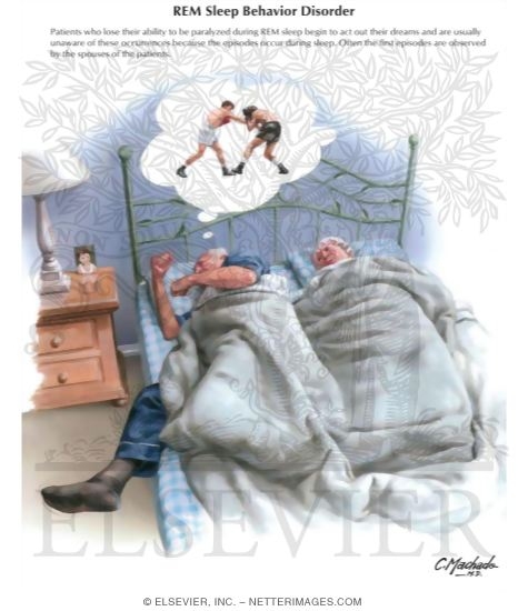 REM Sleep Behavior Disorder