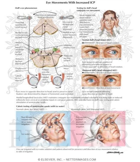 Eye Movements With Increased ICP