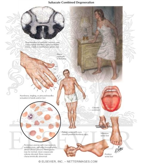 Watermarked preview of labeled image: Subacute Combined Degeneration