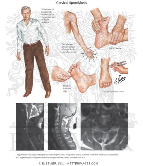 Watermarked preview of labeled image: Cervical Spondylosis