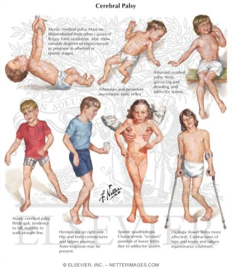 Cerebral Palsy