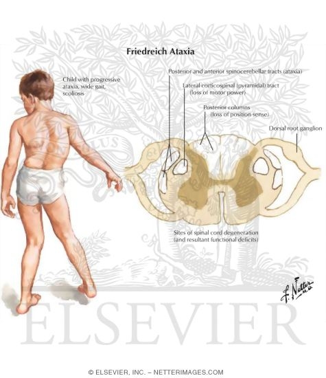Friedreich Ataxia