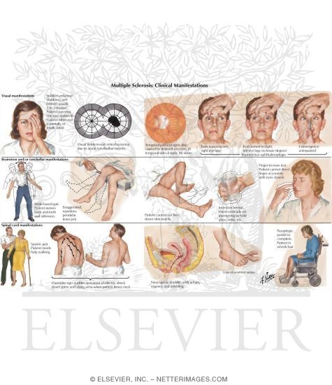 Watermarked preview of labeled image: Multiple Sclerosis: Clinical Manifestations