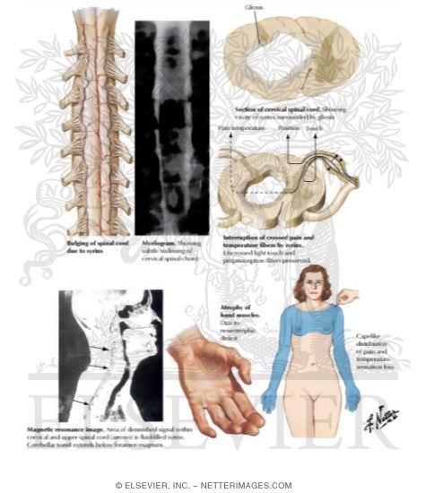 Watermarked preview of labeled image: Syringomyelia