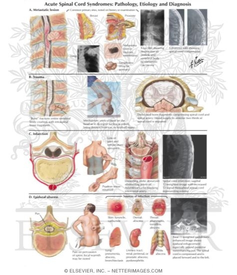 Watermarked preview of labeled image: Acute Spinal Cord Syndromes: Pathology, Etiology, and Diagnosis