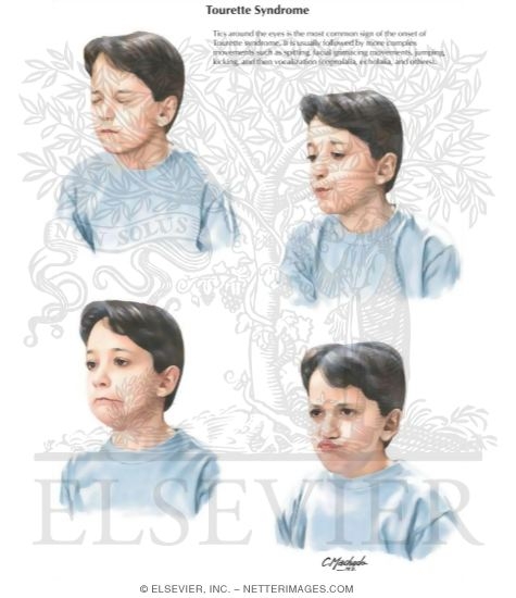 Watermarked preview of labeled image: Tourette Syndrome