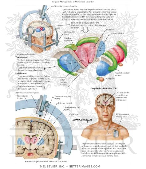 Watermarked preview of labeled image: Surgical Management of Movement Disorders