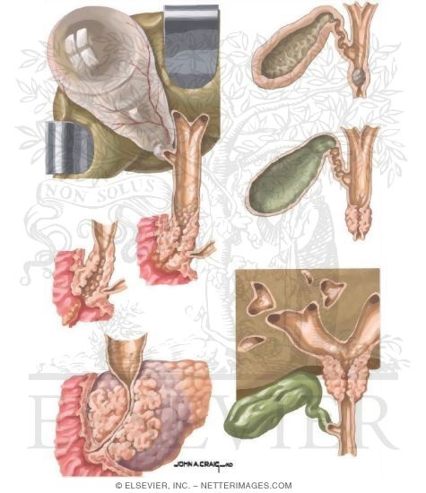 Watermarked preview of unlabeled image: Neoplastic Obstruction of the Bile Ducts