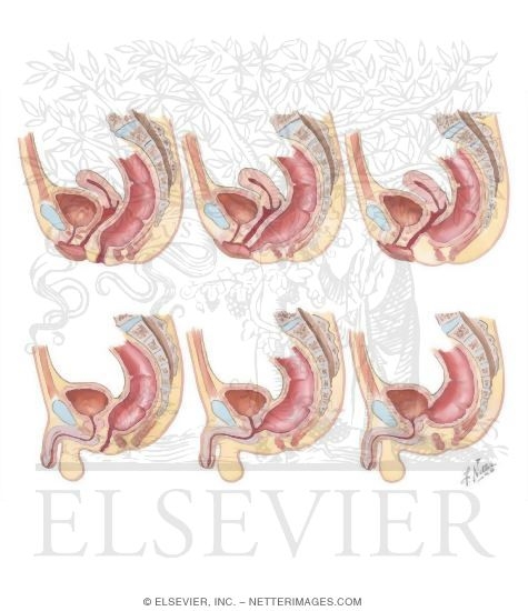 Congenital Cloacal Anomalies