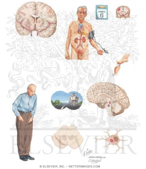 Vascular Dementia and Dementia With Lewy Bodies