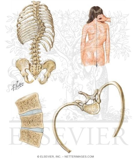 Accentuated Spinal Curvatures