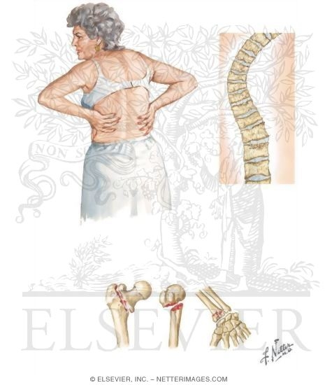 Watermarked preview of unlabeled image: Osteoporosis