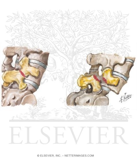 Watermarked preview of unlabeled image: Spondylolysis and Spondylolisthesis
