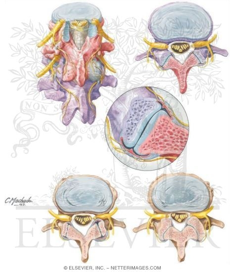 Back Pain Associated With Vertebral Facet Joints