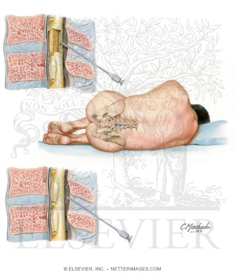 Watermarked preview of unlabeled image: Lumbar Puncture and Epidural Anesthesia