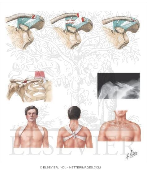 Watermarked preview of unlabeled image: Clavicular Fractures
