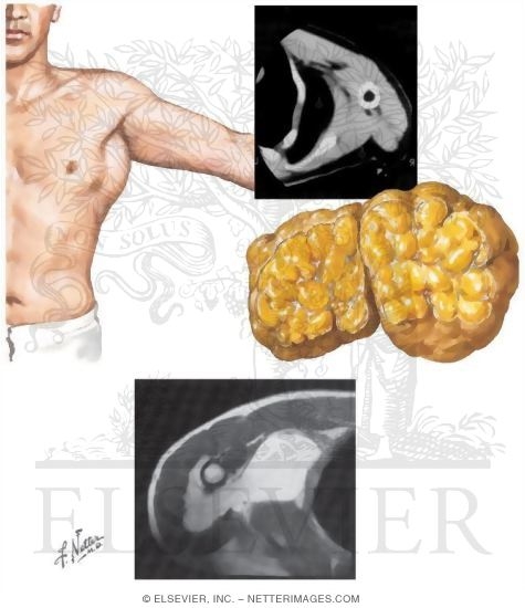 Soft Tissue Tumor of the Axilla