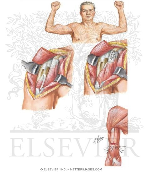 Watermarked preview of unlabeled image: Rupture of the Biceps Brachii Muscle