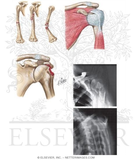 Watermarked preview of unlabeled image: Fractures of the Humerus