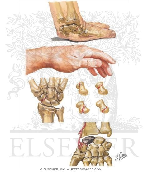 Watermarked preview of unlabeled image: Fracture of the Scaphoid